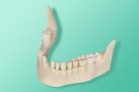 The model of  the jaw with retained wisdom teeth for installation in phantoms 10-3022