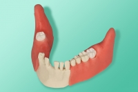 The model of  the jaw with retained wisdom teeth for installation in phantoms 10-3042