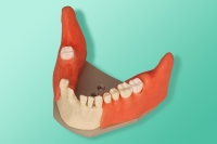 The model of the jaw with retained wisdom teeth for installation in phantoms 10-3047