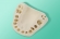 The edentulous jaw model is designed for training in immediate implant 10-5077